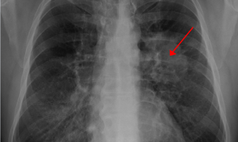 Röntgenbild av lunga. Pilen markerar en tumör.